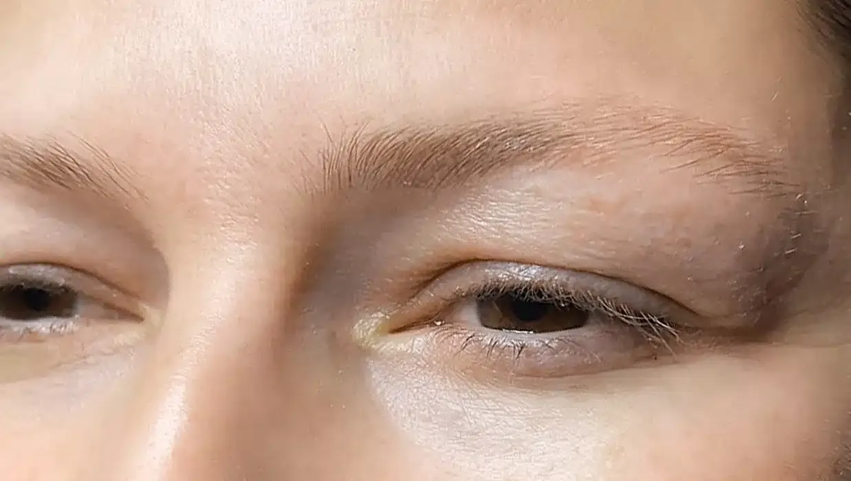 laminace_browlift_before